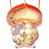 Аденома простати