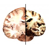 Хвороба Альцгеймера