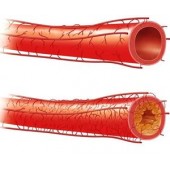 Атеросклероз