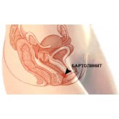 Бартолініт