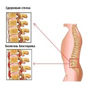 Хвороба Бєхтєрєва (анкілозуючий спондилоартрит)