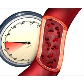 Гіпертензія (Гіпертонія)
