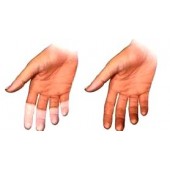 Хвороба Рейно (суха двостороння гангрена)