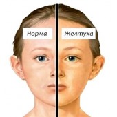 Синдром Жильбера