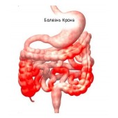 Хвороба Крона