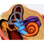 Хвороба Меньєра