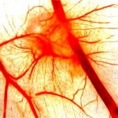 Пурпура Шенлейн-Геноха